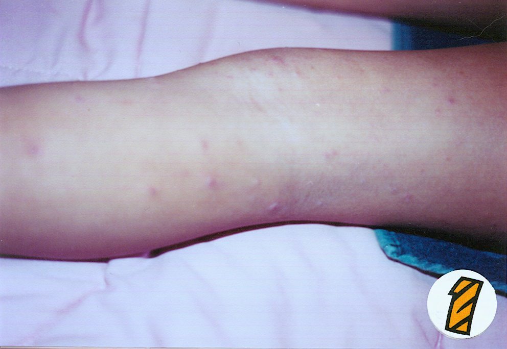 child rash on legs #10