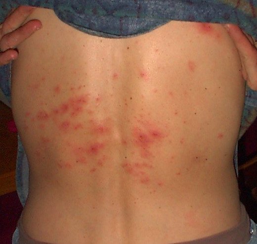 herpes zoster shingles. Picture of Shingles (Herpes